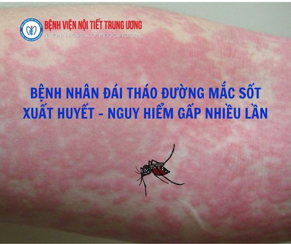 NGƯỜI BỆNH ĐÁI THÁO ĐƯỜNG MẮC SỐT XUẤT HUYẾT – NGUY HIỂM GẤP NHIỀU LẦN