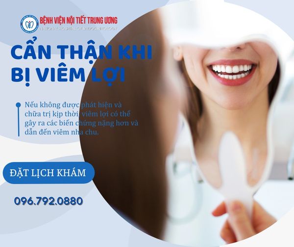 Bạn có biết viêm lợi là nguyên nhân chính gây rụng răng?