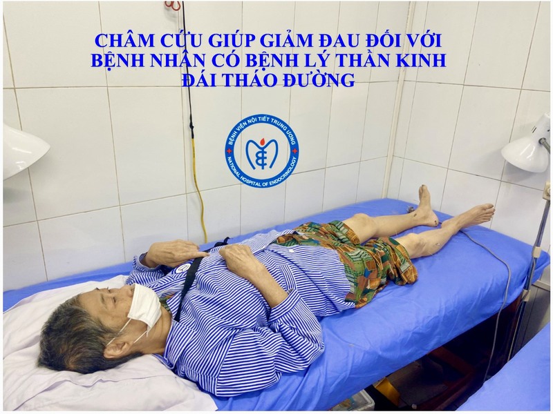 CHÂM CỨU GIÚP GIẢM ĐAU ĐỐI VỚI BỆNH NHÂN CÓ BỆNH THẦN KINH ĐÁI THÁO ĐƯỜNG