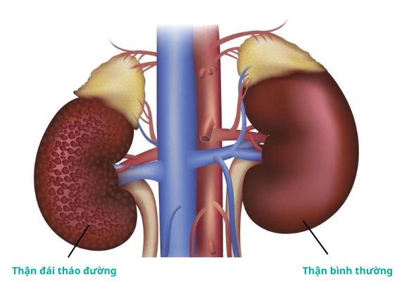 Vai trò quan trọng của việc phát hiện sớm bệnh thận do đái tháo đường