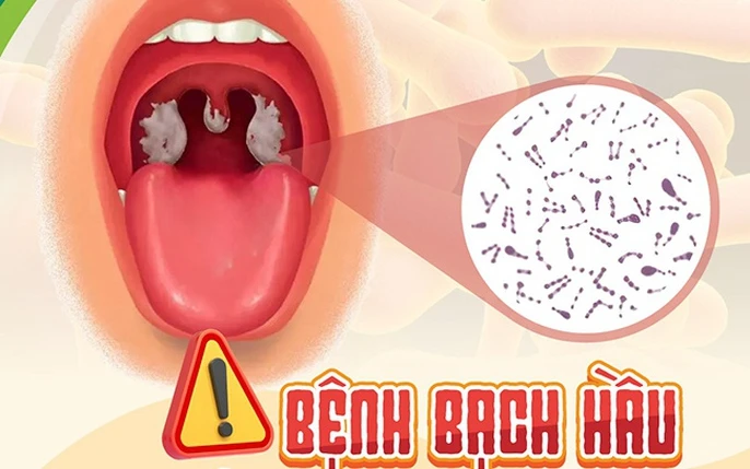 Bệnh bạch hầu: Những biến chứng nguy hiểm và cách phòng bệnh