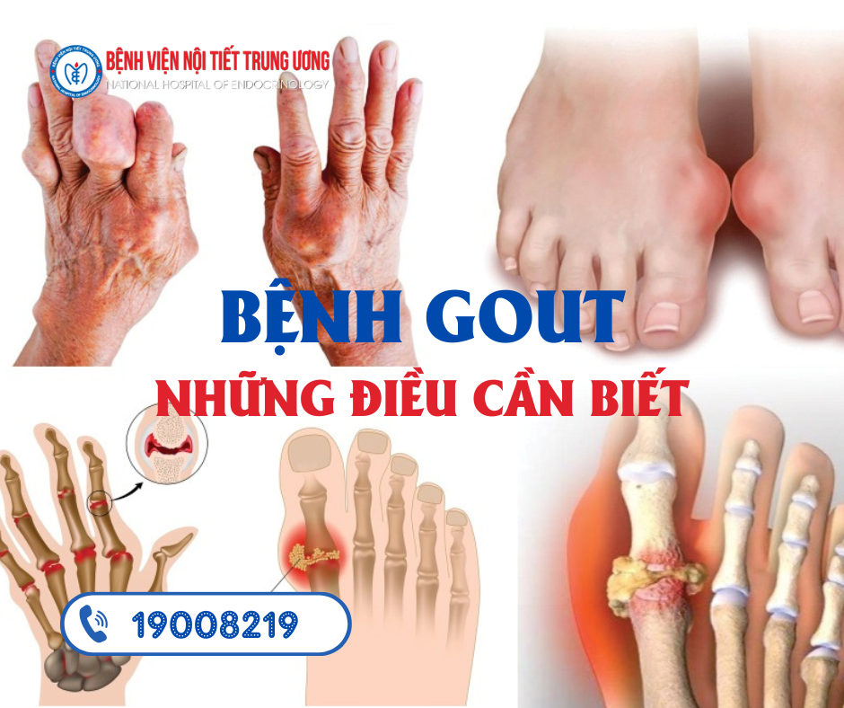 Bệnh gout những điều cần biết