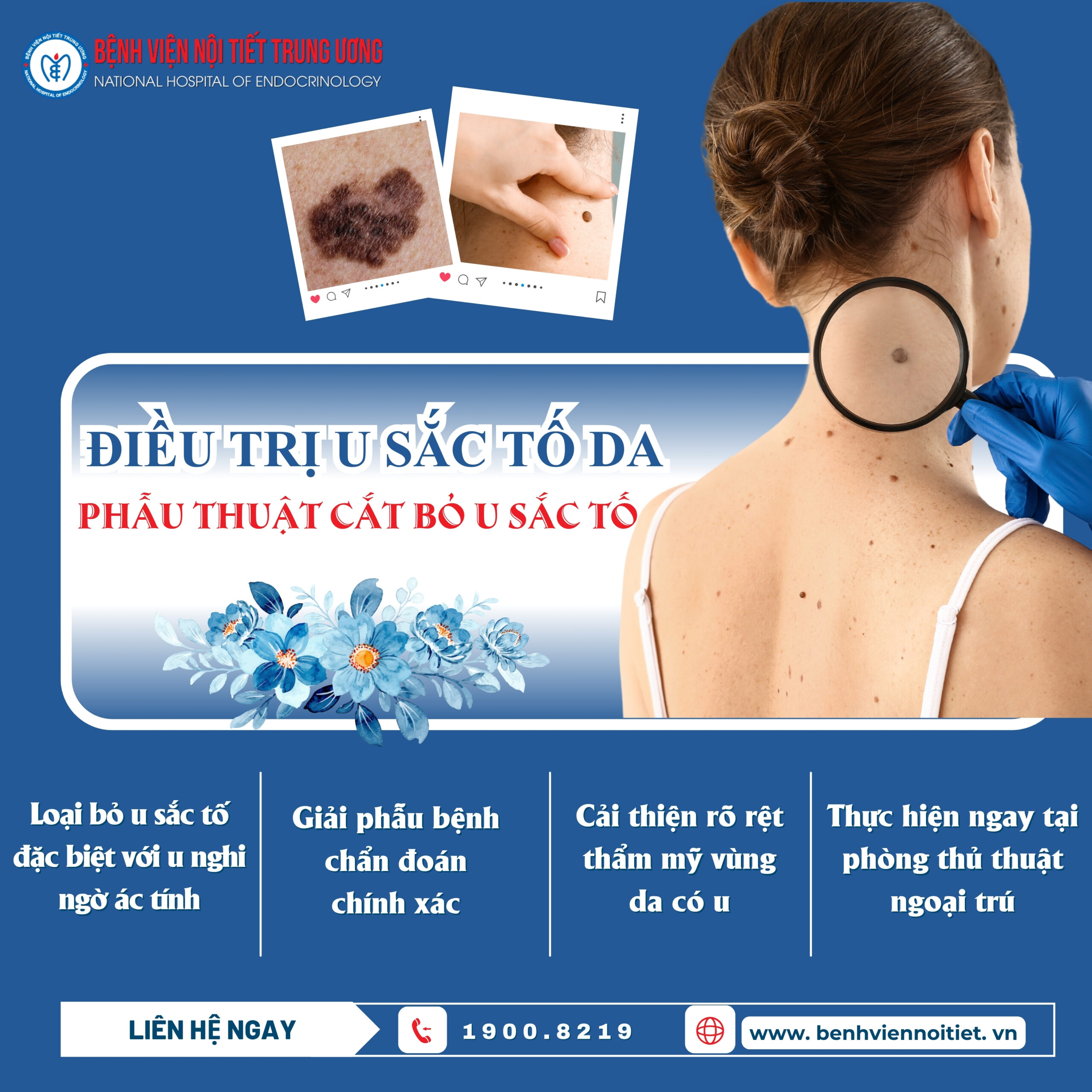 KINH88 trang cá độ bóng đá trực tiếp cắt u sắc tố – giải pháp thẩm mỹ an toàn cho làn da hoàn hảo