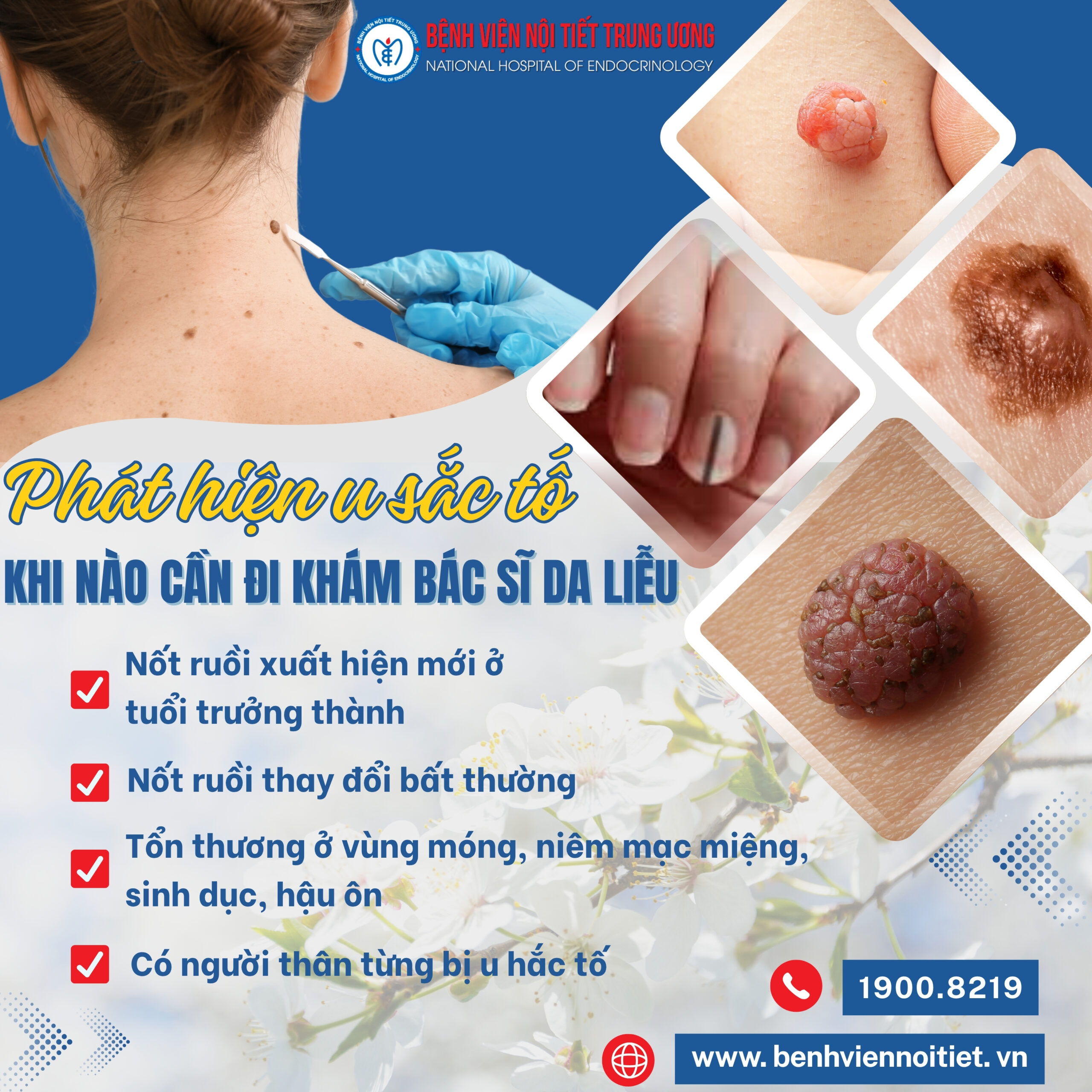 Phát hiện u sắc tố – khi nào cần đi khám da liễu?