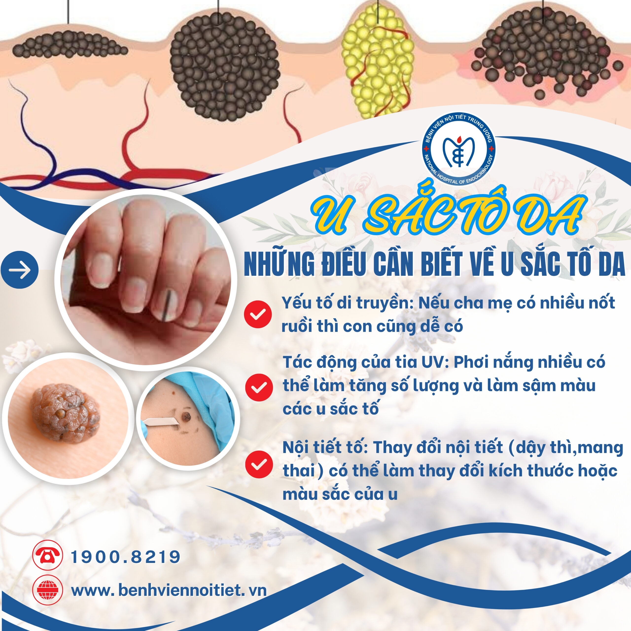 Những điều bạn cần biết về u sắc tố da