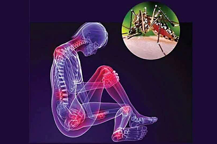 Phân biệt dấu hiệu mắc Chikungunya với sốt xuất huyết