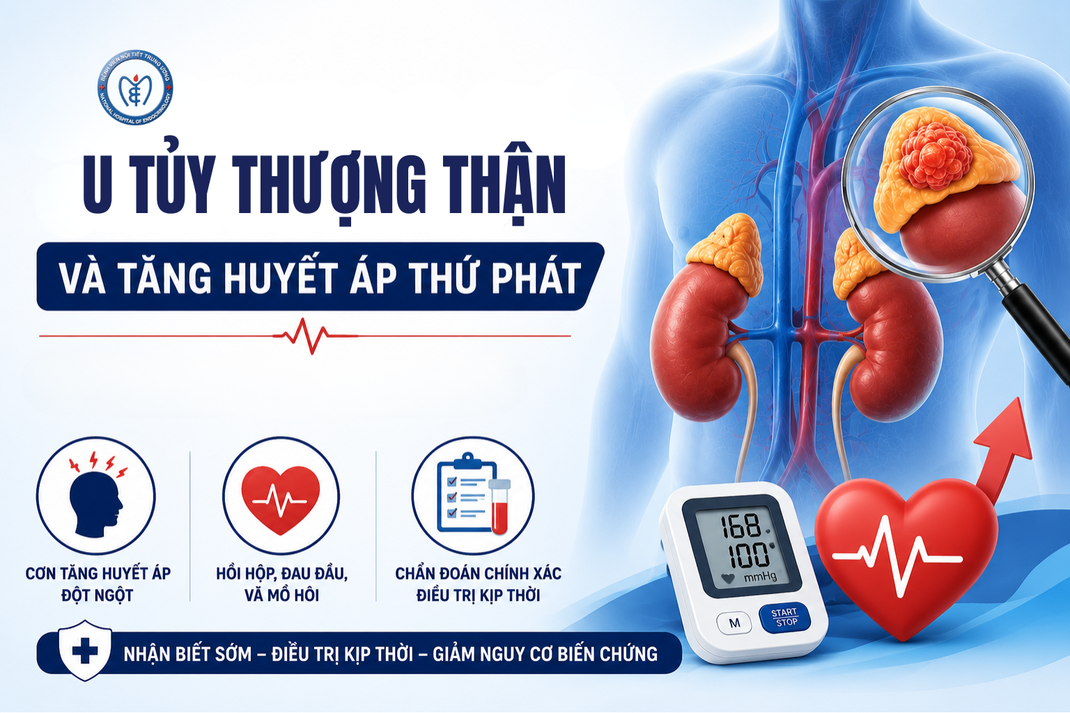 U tủy thượng thận (pheochromocytoma) và tăng Nhà Cái Cá Cược Uy Tín King88 Vina thứ phát